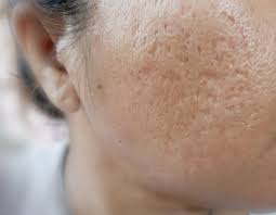 Acne Scar Treatment in Aundh
