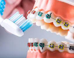Oral Care During Orthodontic Treatment: Keeping Braces Clean and Healthy – Grace Clinic Dental Skin Hair and Laser
