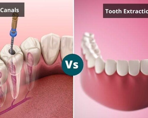 Root Canal vs. Tooth Extraction: Making the Right Choice for Your Dental Health