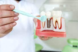 Caring for Your Dental Implants: Tips for Long-Term Success at Grace Clinic Dental Skin Hair and Laser in Aundh