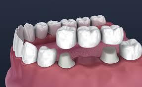 The Lifespan of Dental Crowns and Bridges: Maintenance and Care
