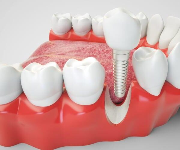 5 Reasons Why Dental Implants are Popular