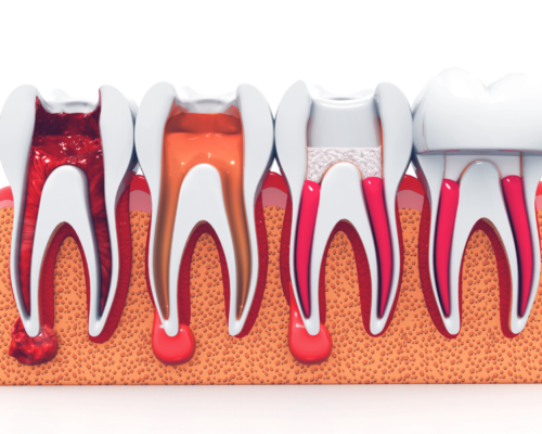 Preserving Your Natural Smile: The Cosmetic Benefits of Root Canal Therapy