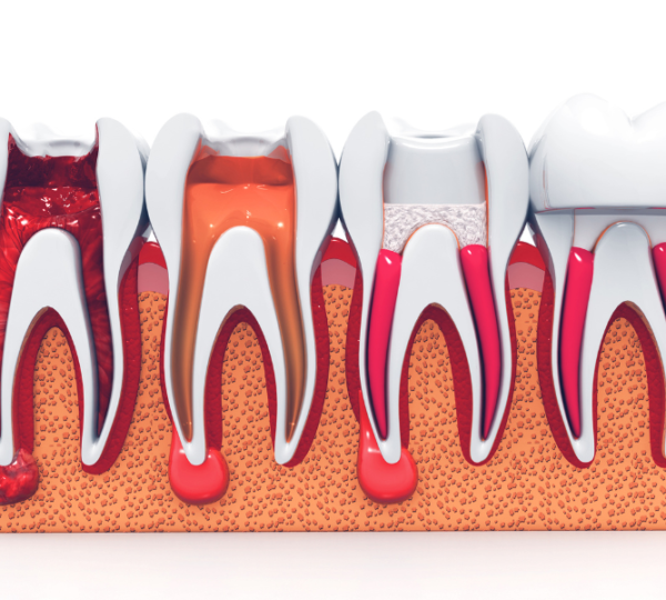 Preserving Your Natural Smile: The Cosmetic Benefits of Root Canal Therapy